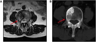 Robot and working tube-assisted invasion-controlled surgery for spinal metastases
